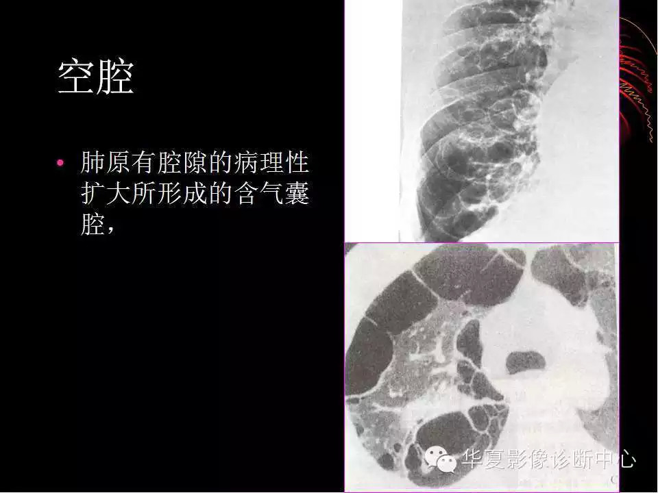 肺与纵隔的影像诊断