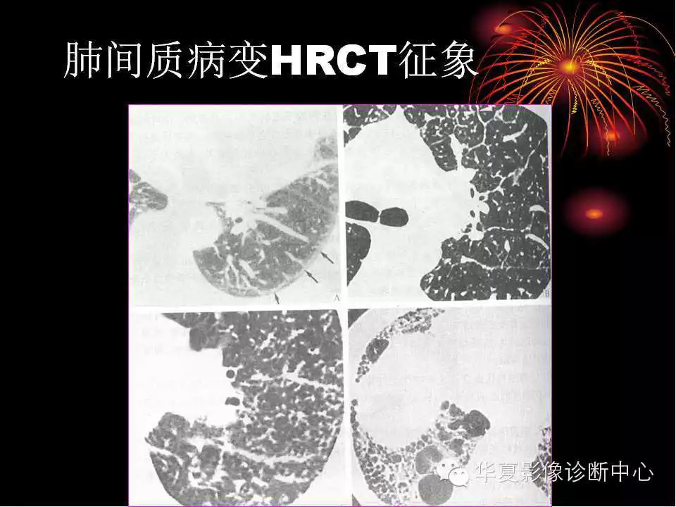 肺与纵隔的影像诊断