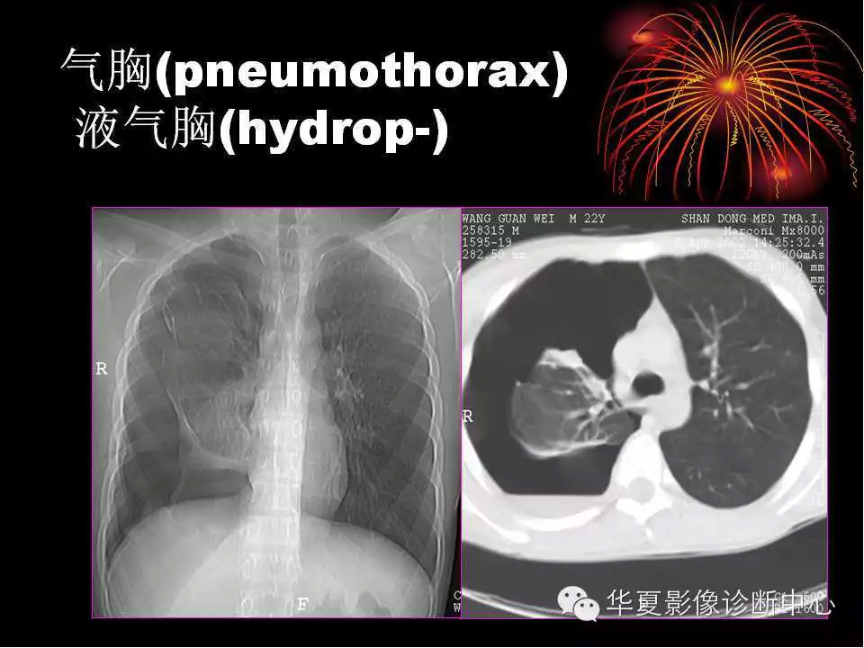 肺与纵隔的影像诊断