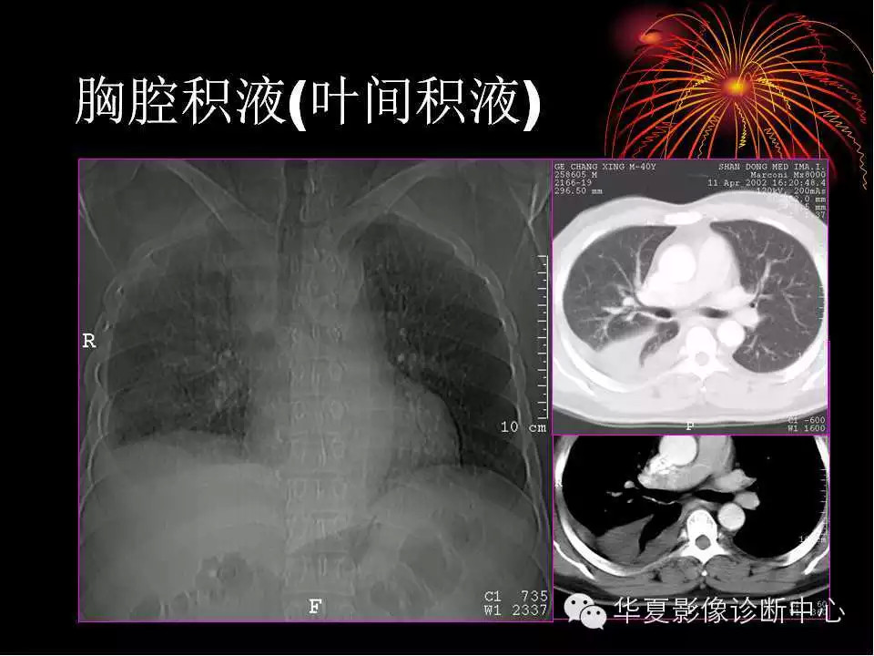 肺与纵隔的影像诊断
