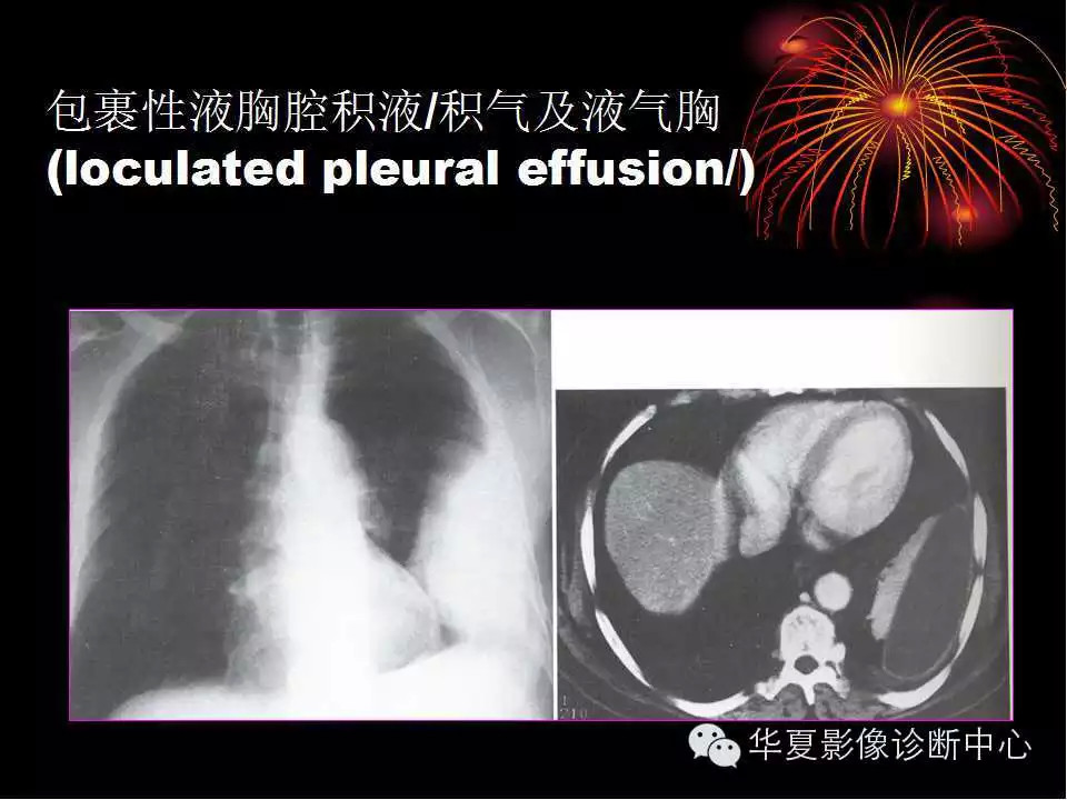 肺与纵隔的影像诊断