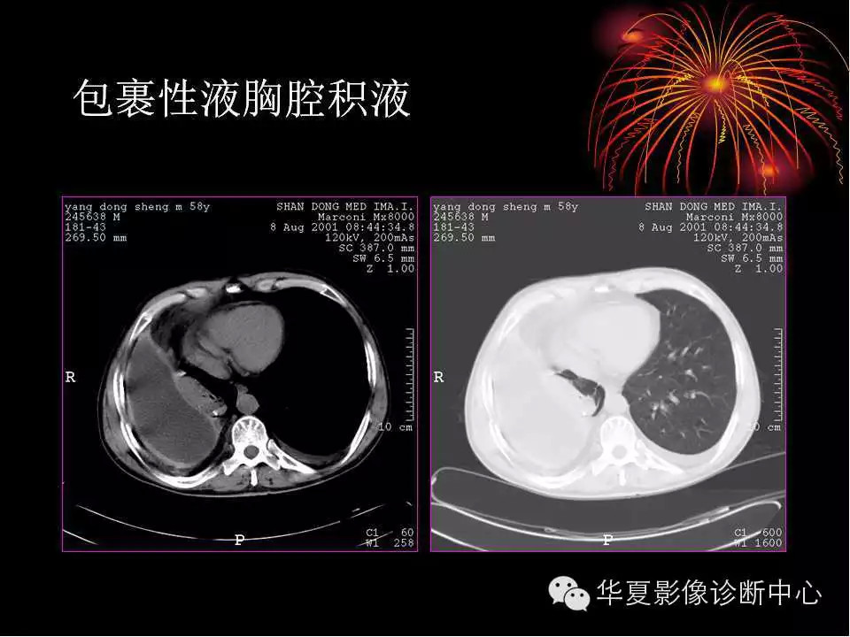 肺与纵隔的影像诊断