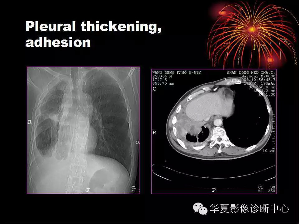 肺与纵隔的影像诊断