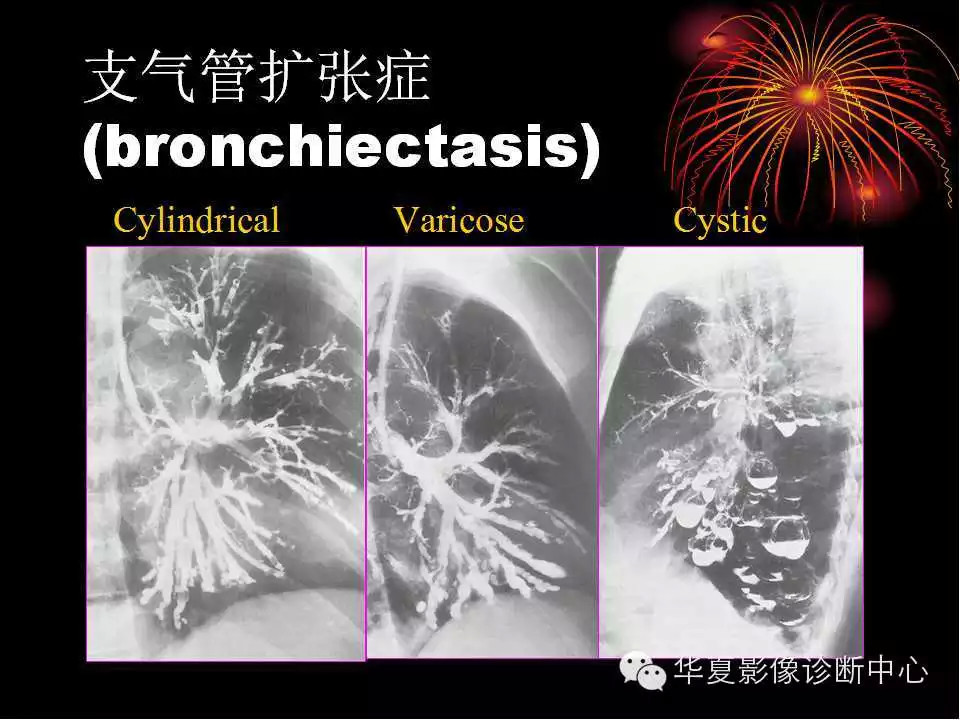 肺与纵隔的影像诊断