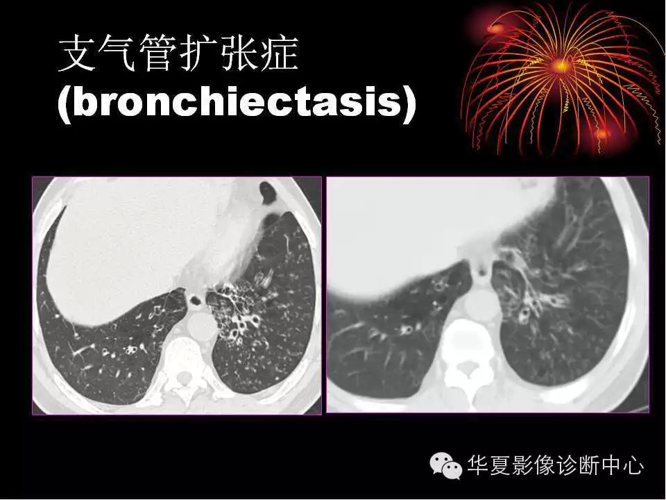 肺与纵隔的影像诊断