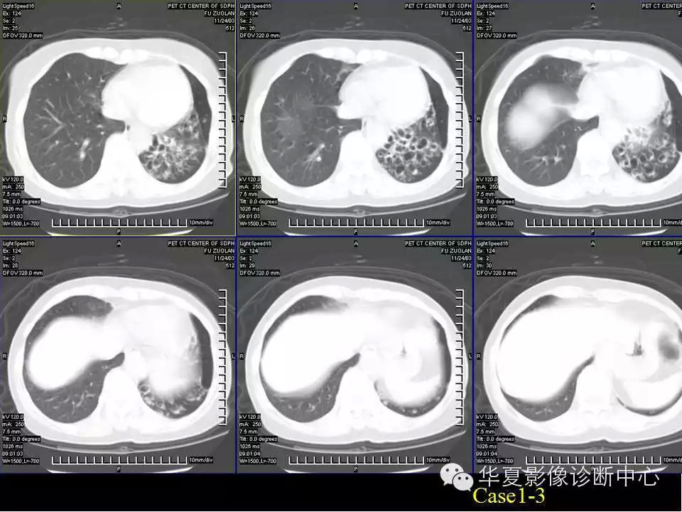 肺与纵隔的影像诊断