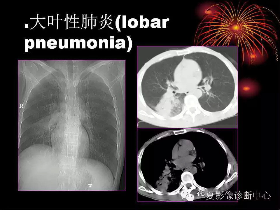 肺与纵隔的影像诊断