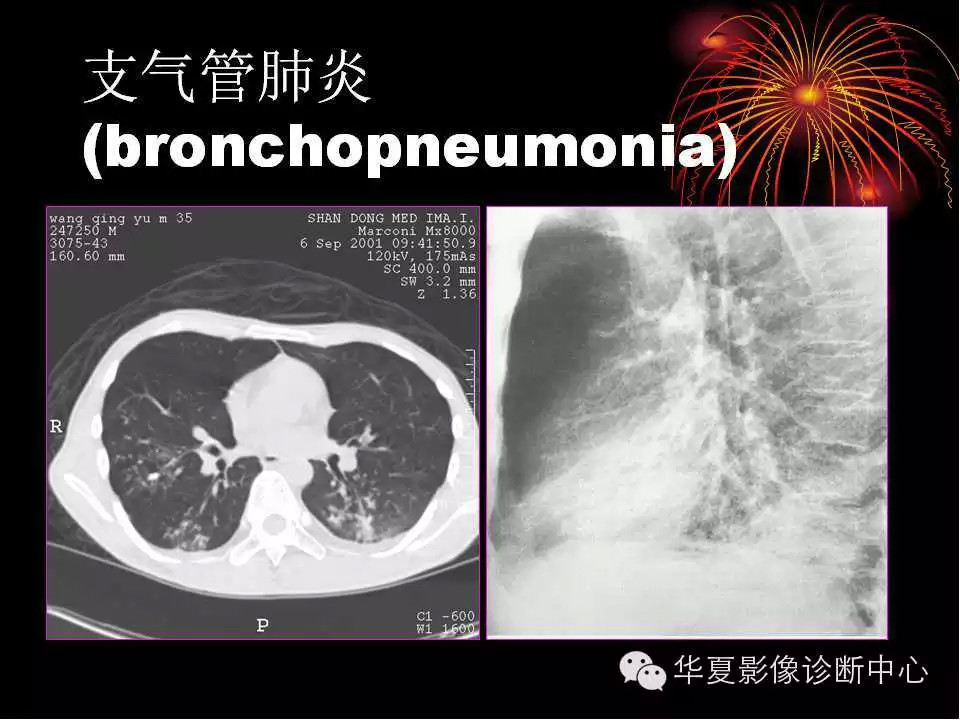 肺与纵隔的影像诊断
