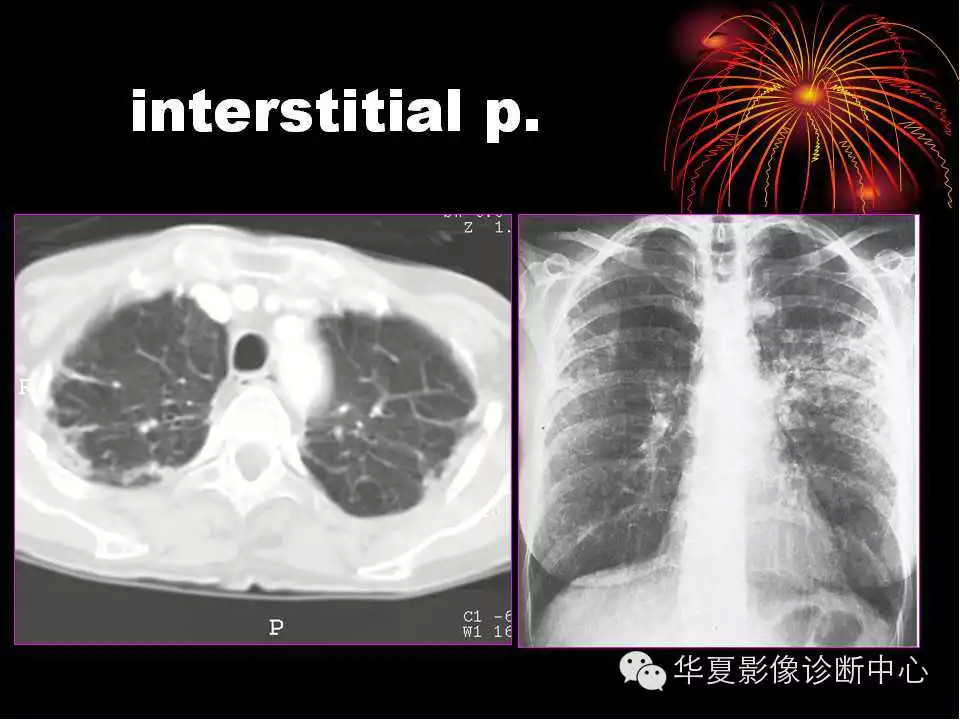 肺与纵隔的影像诊断