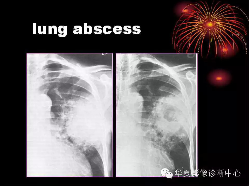 肺与纵隔的影像诊断