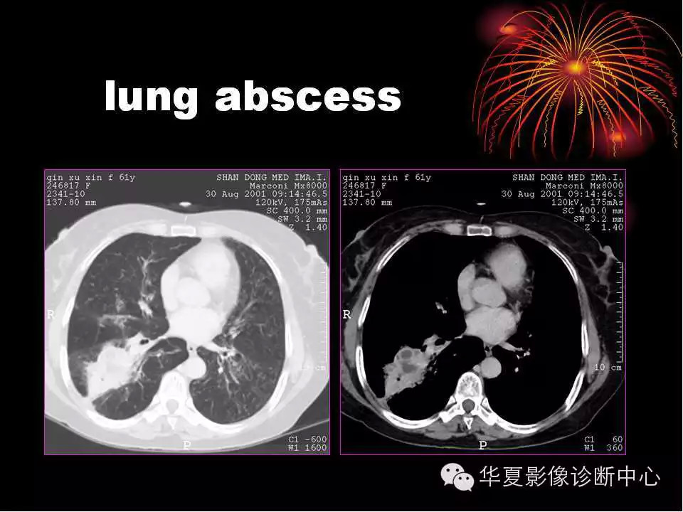 肺与纵隔的影像诊断