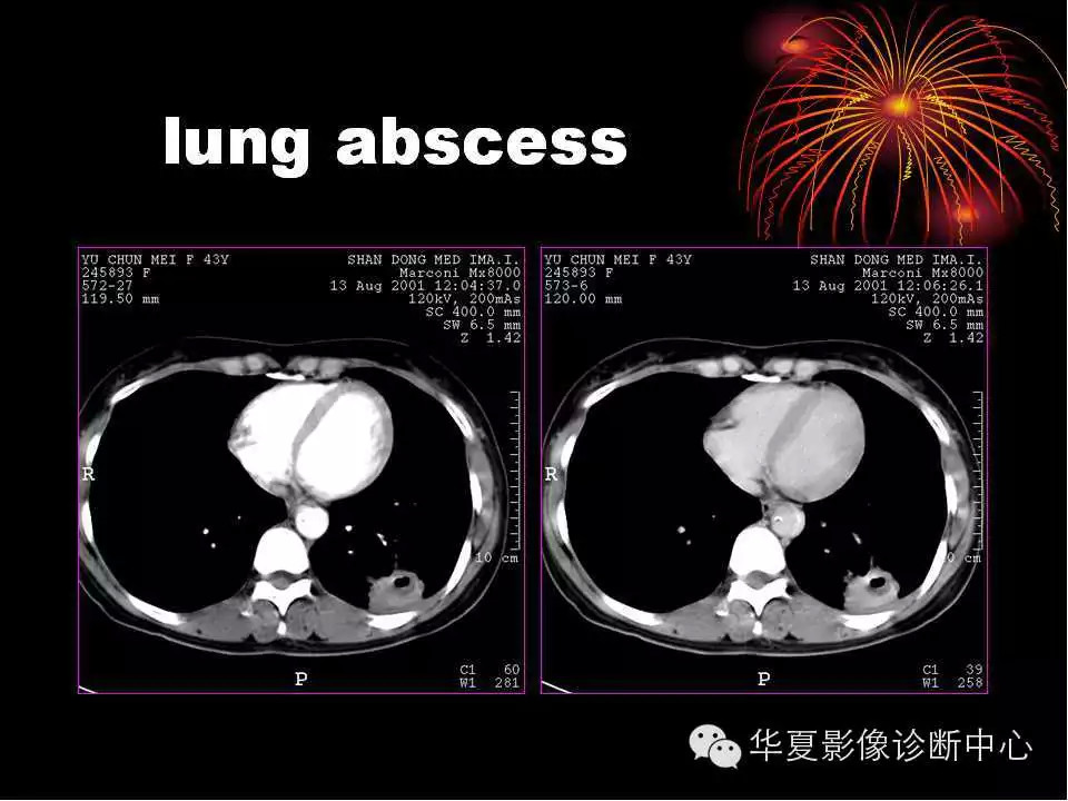 肺与纵隔的影像诊断