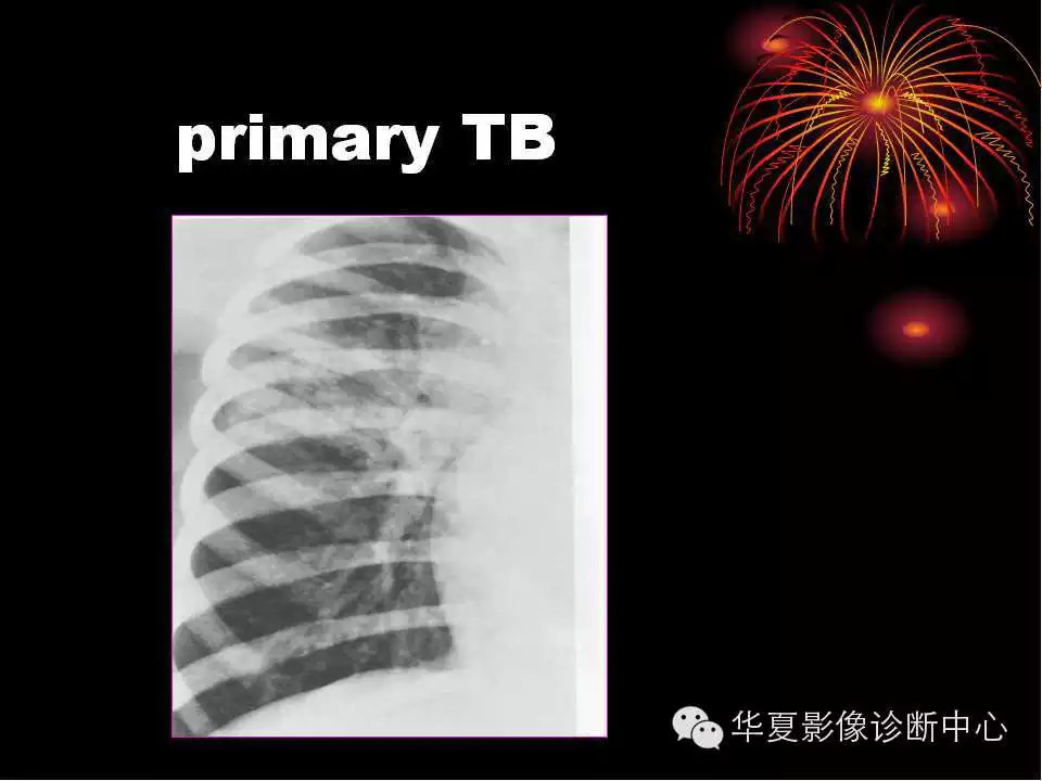 肺与纵隔的影像诊断