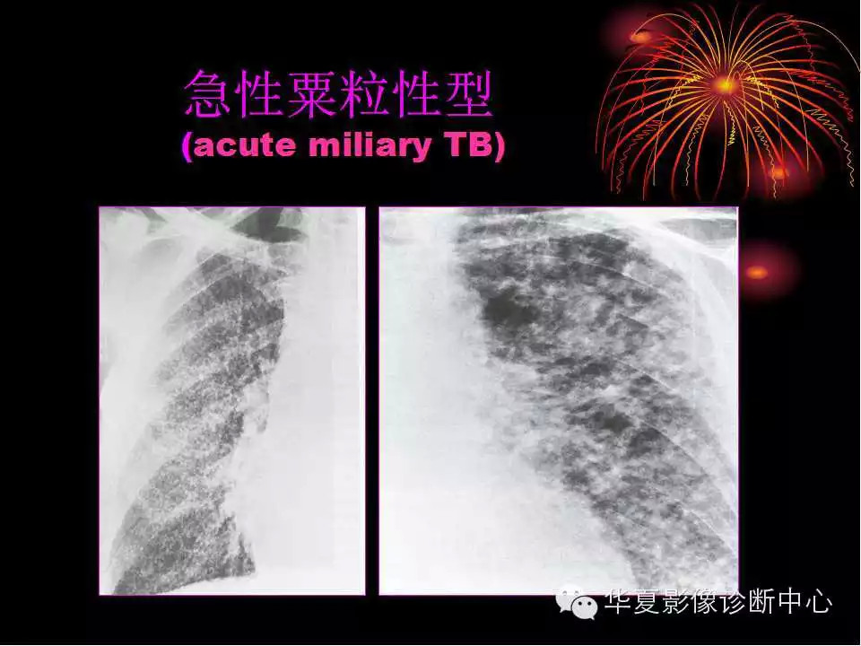 肺与纵隔的影像诊断