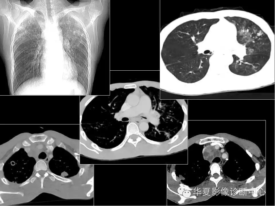 肺与纵隔的影像诊断
