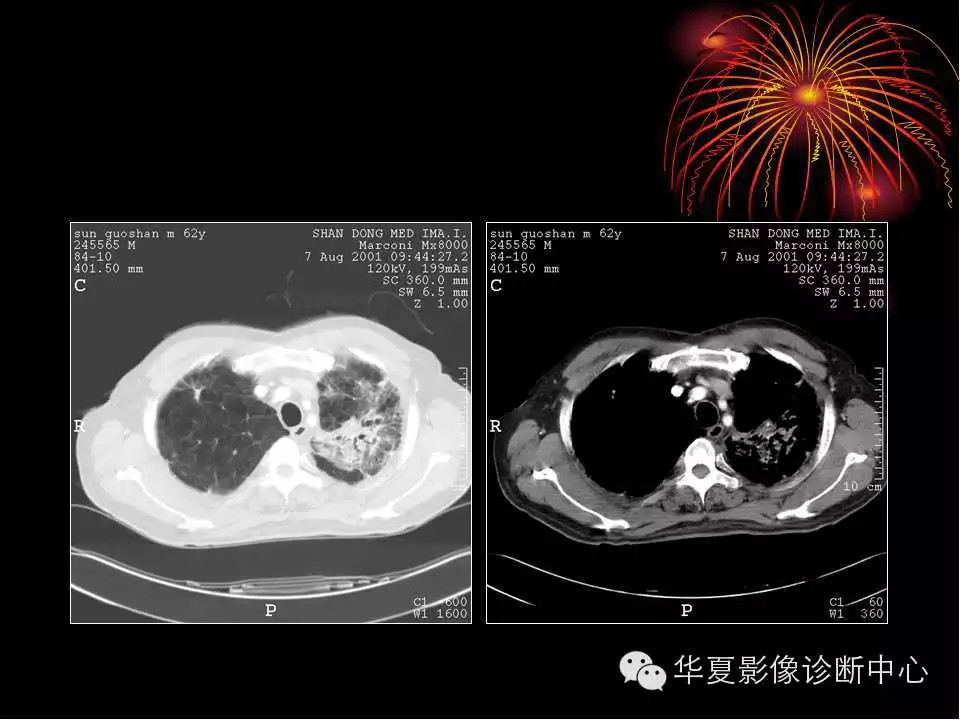 肺与纵隔的影像诊断