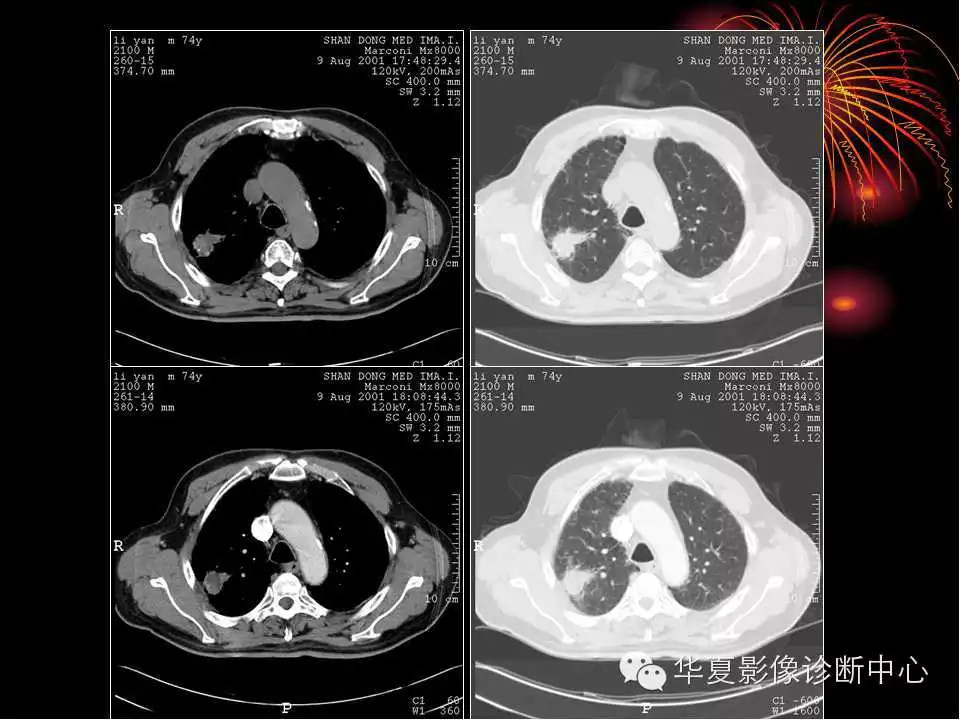 肺与纵隔的影像诊断