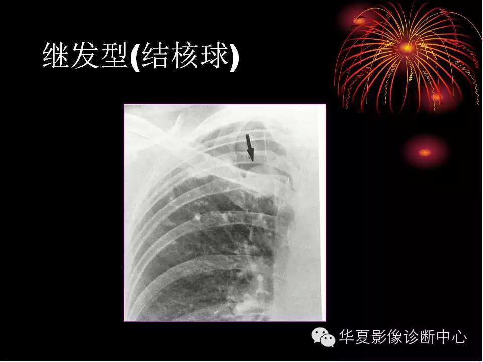 肺与纵隔的影像诊断