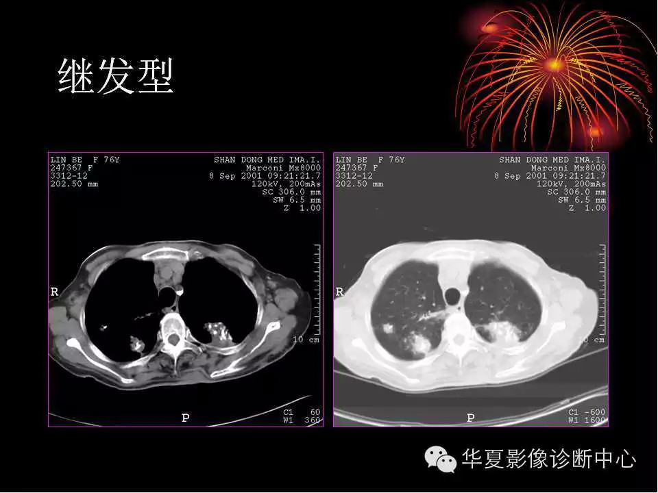 肺与纵隔的影像诊断