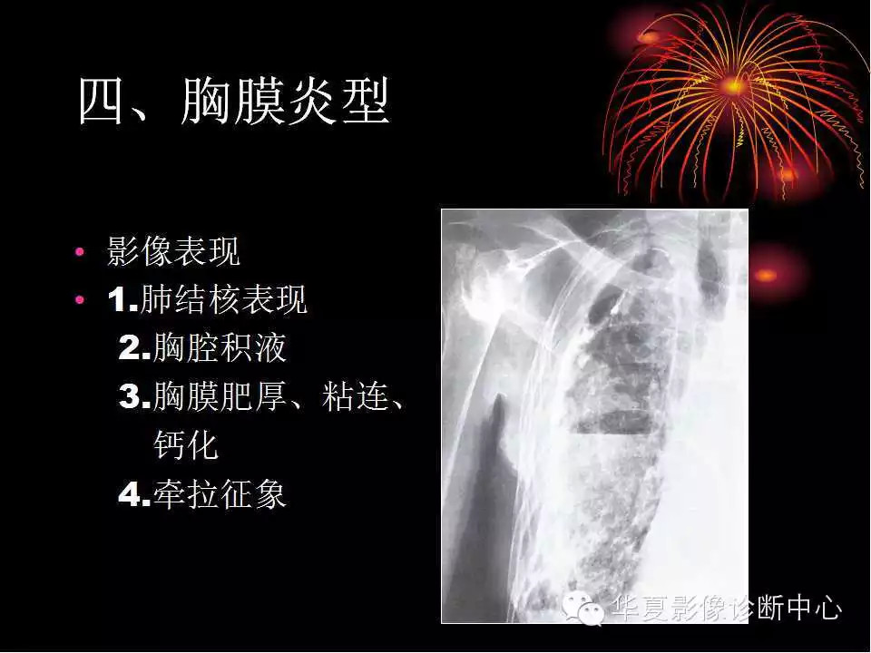 肺与纵隔的影像诊断