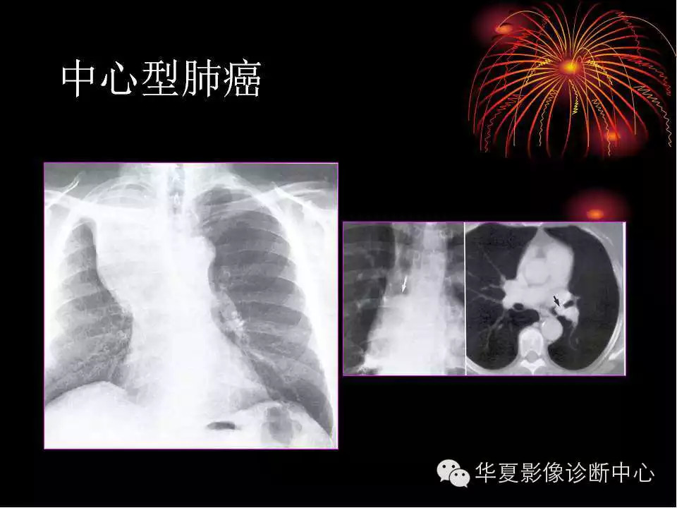 肺与纵隔的影像诊断