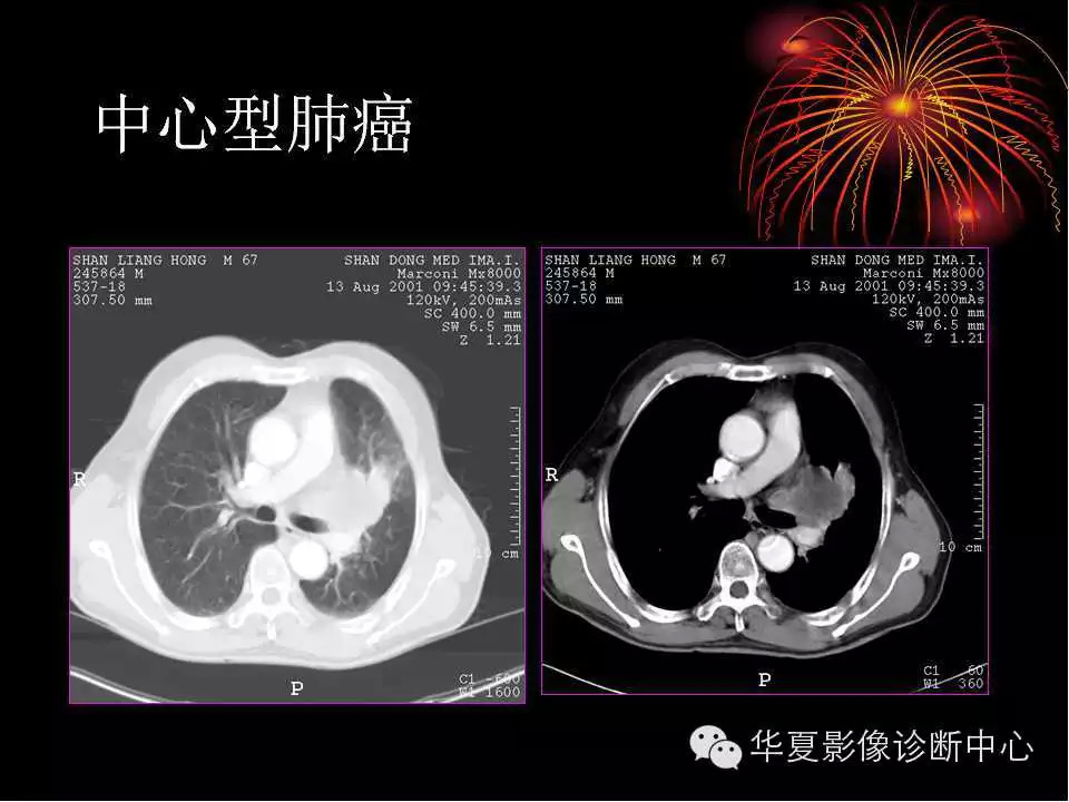 肺与纵隔的影像诊断