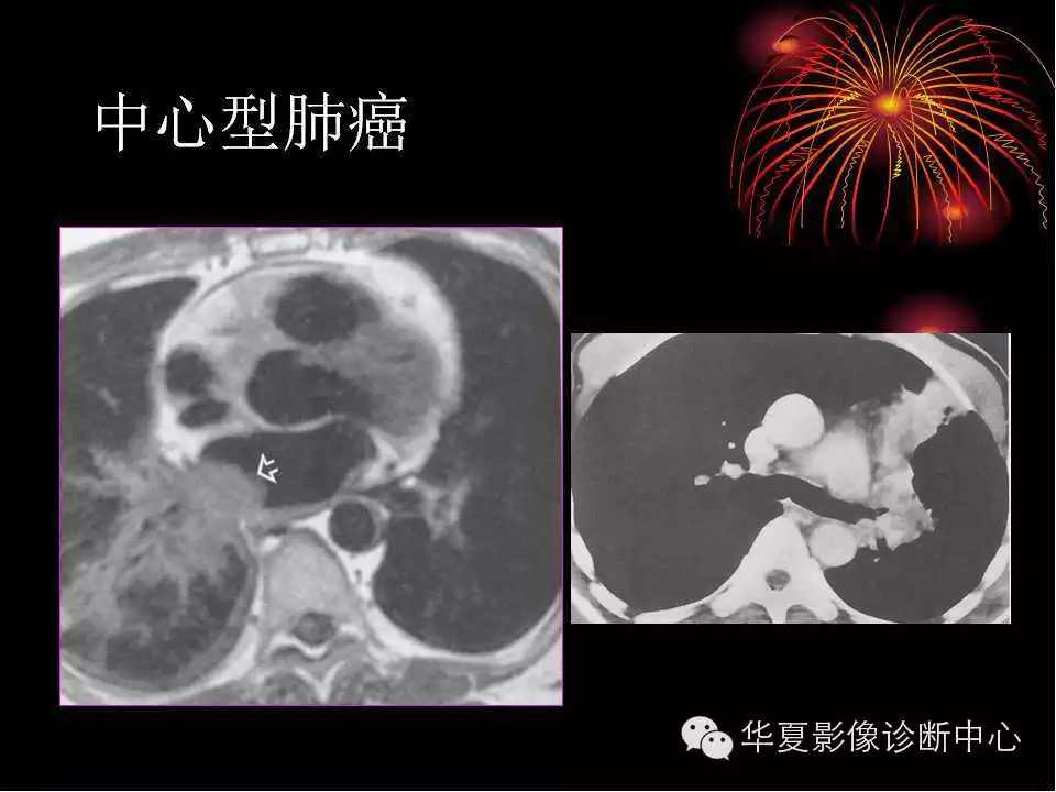 肺与纵隔的影像诊断