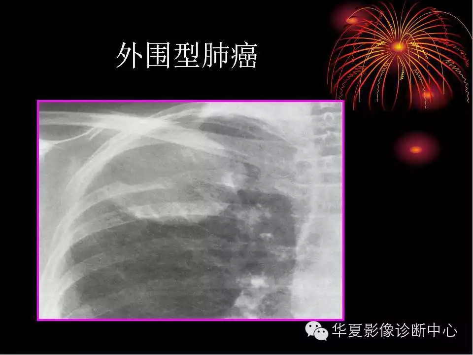 肺与纵隔的影像诊断