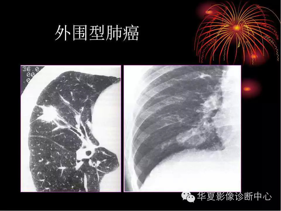 肺与纵隔的影像诊断