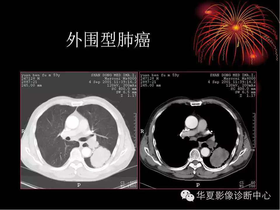 肺与纵隔的影像诊断