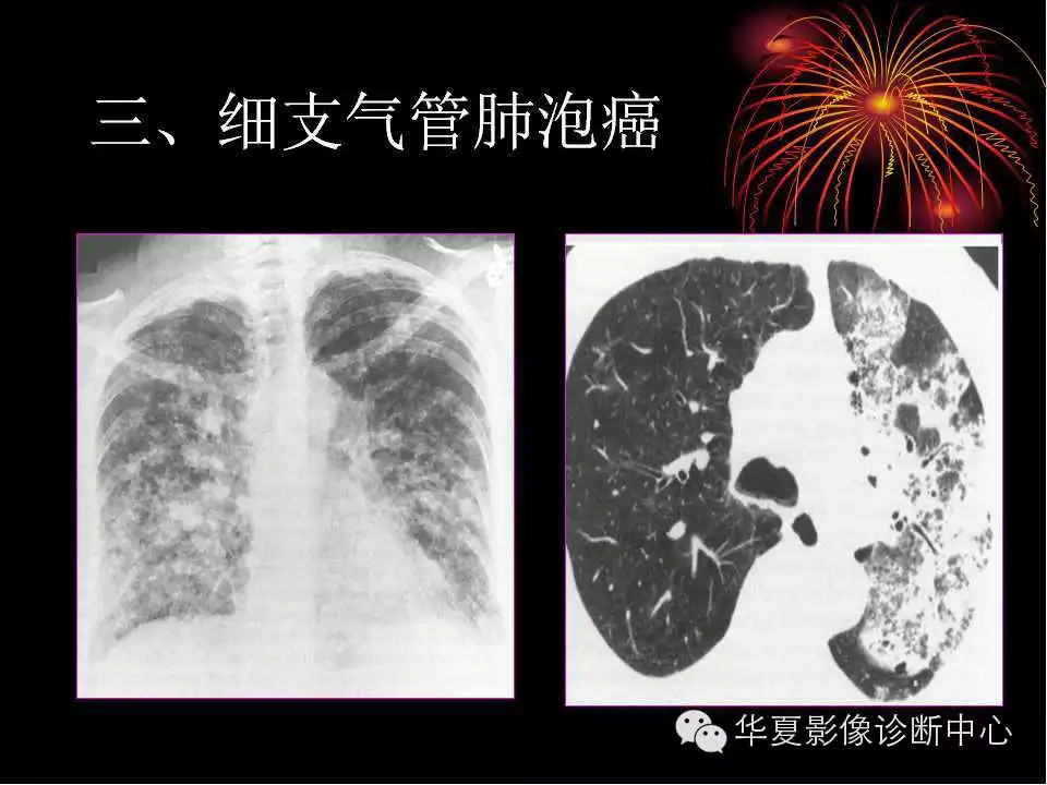 肺与纵隔的影像诊断