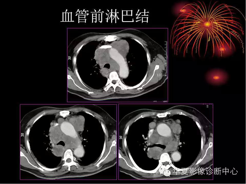 肺与纵隔的影像诊断