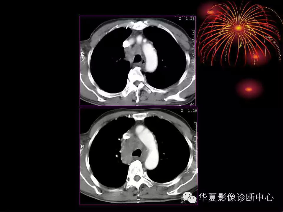 肺与纵隔的影像诊断