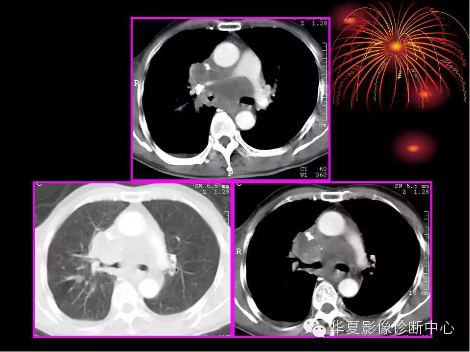 肺与纵隔的影像诊断