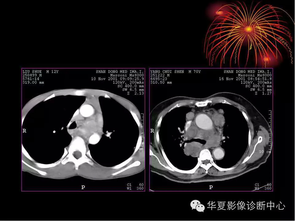 肺与纵隔的影像诊断