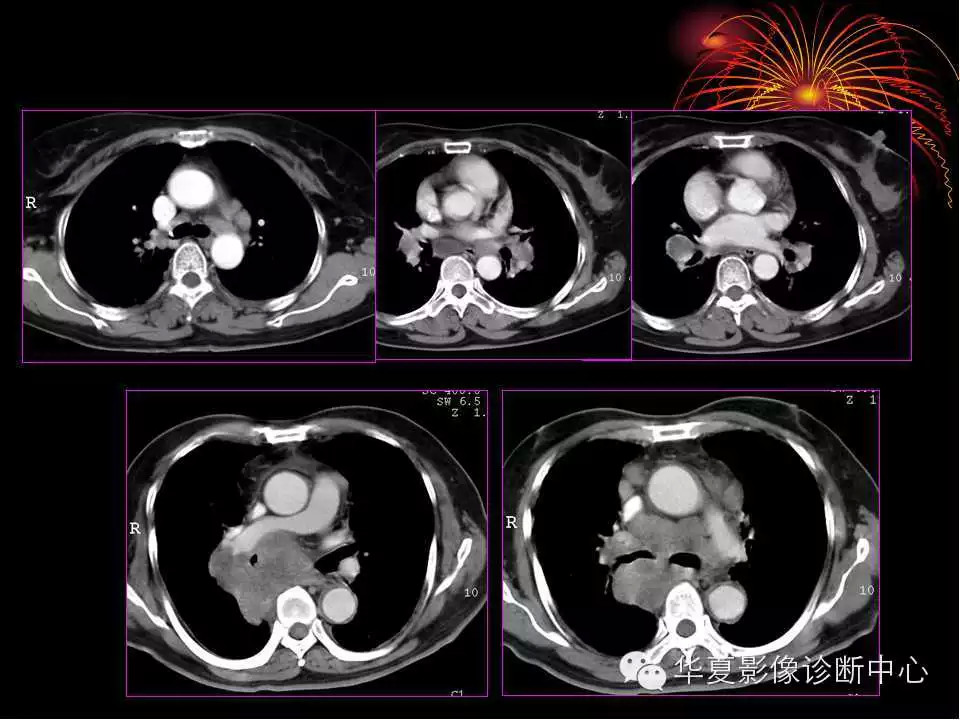 肺与纵隔的影像诊断