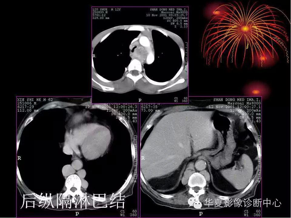 肺与纵隔的影像诊断