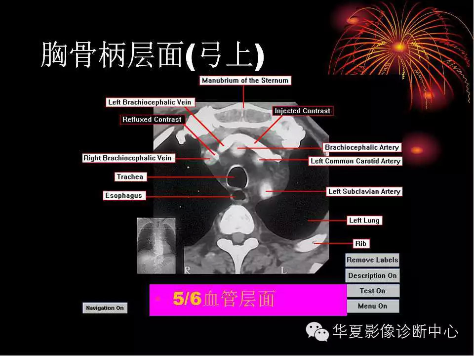 肺与纵隔的影像诊断
