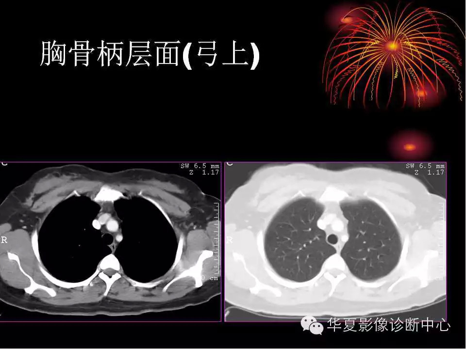 肺与纵隔的影像诊断