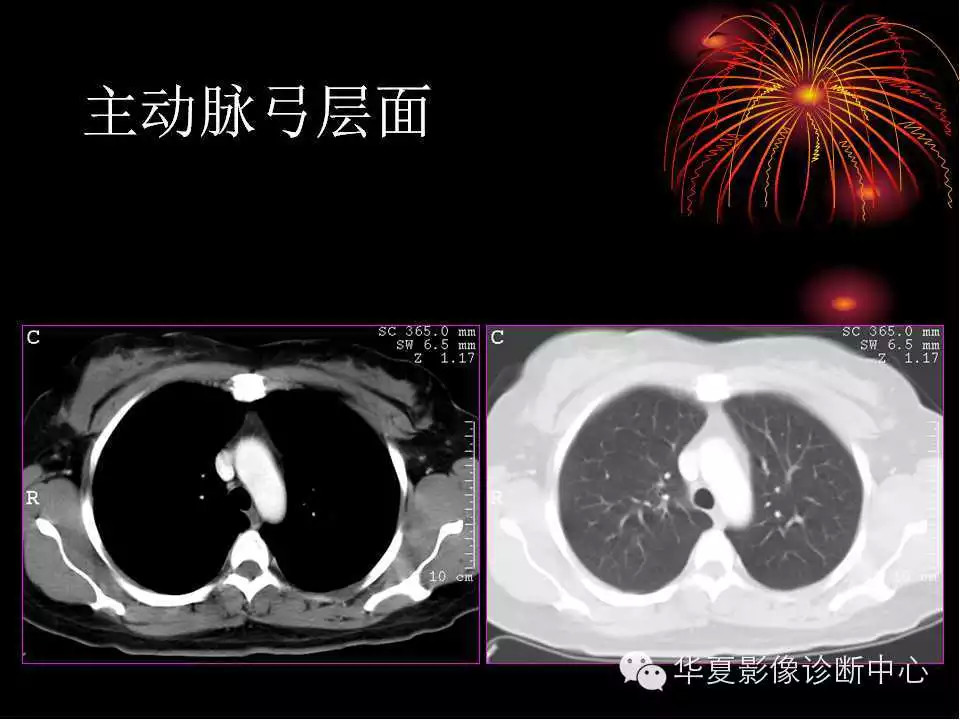 肺与纵隔的影像诊断