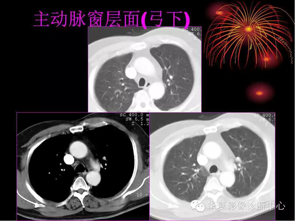肺与纵隔的影像诊断