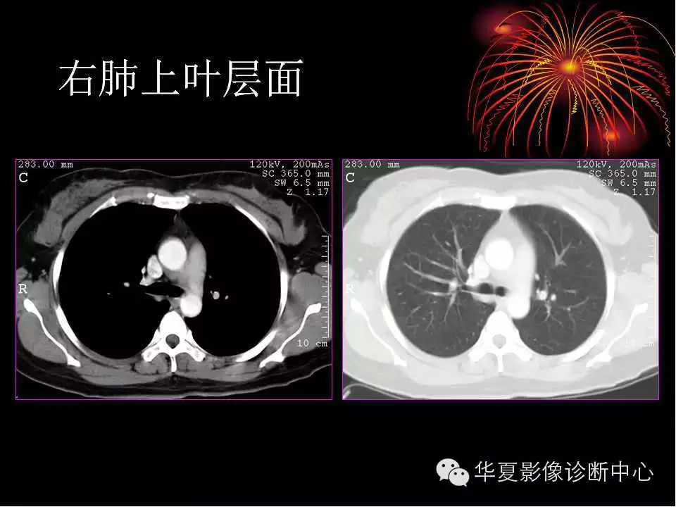 肺与纵隔的影像诊断