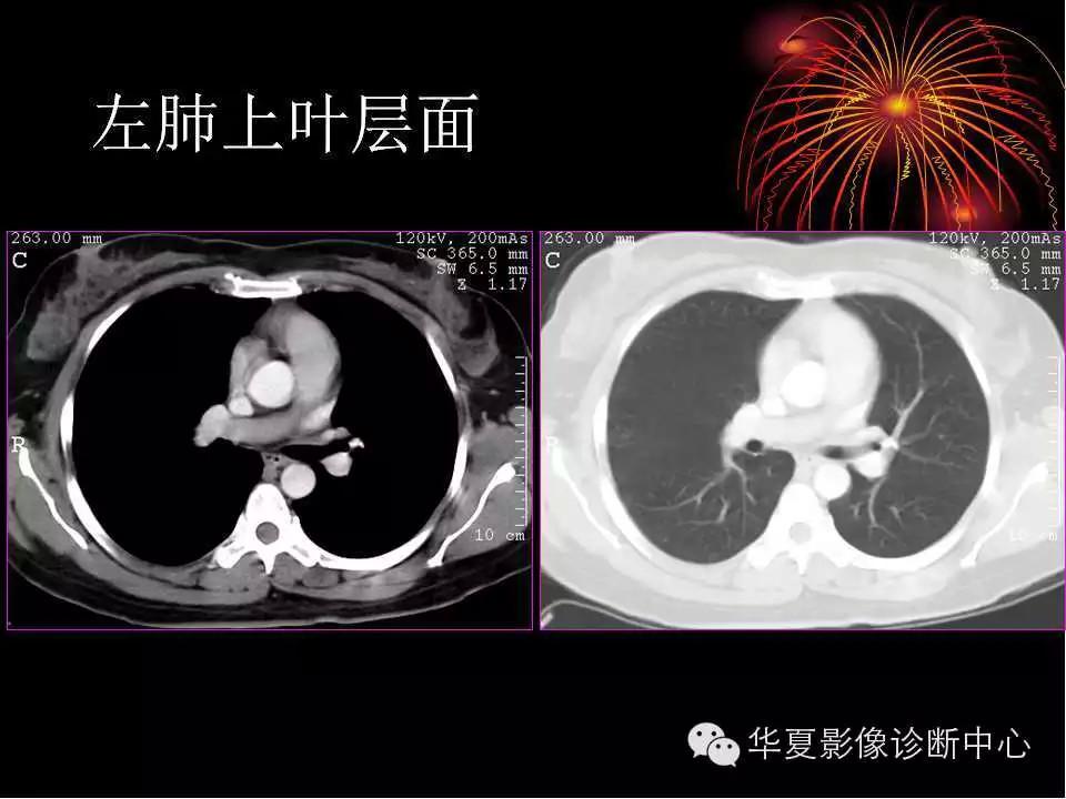 肺与纵隔的影像诊断