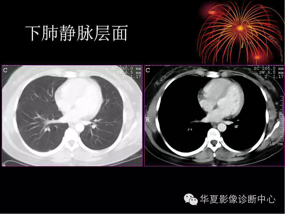 肺与纵隔的影像诊断