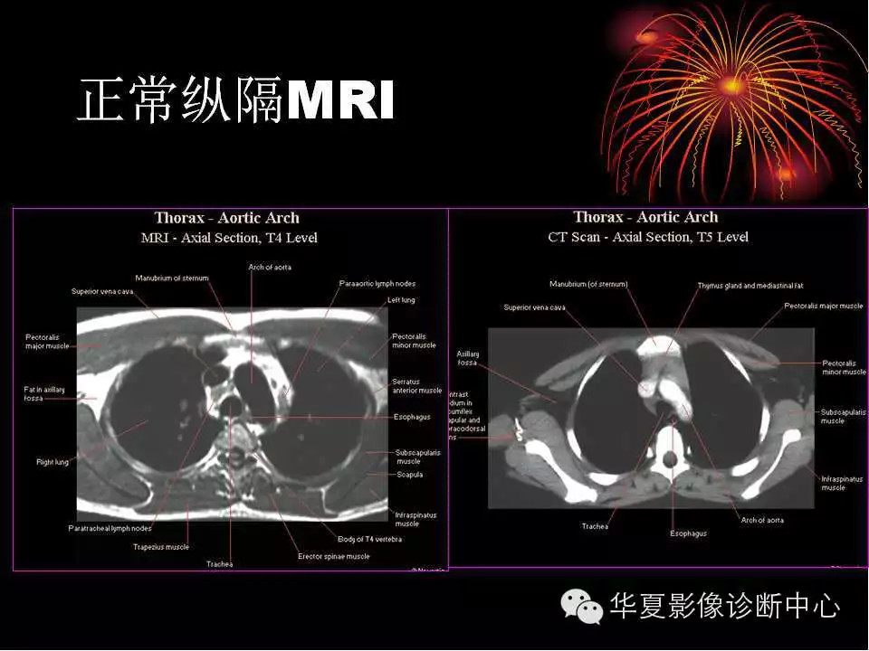 肺与纵隔的影像诊断