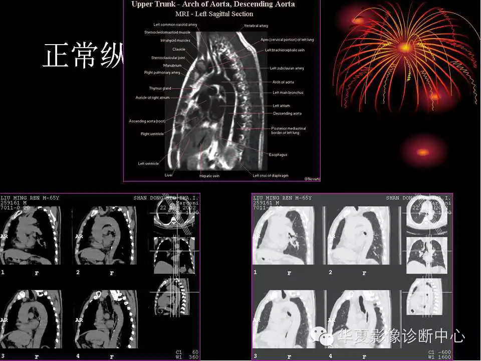 肺与纵隔的影像诊断