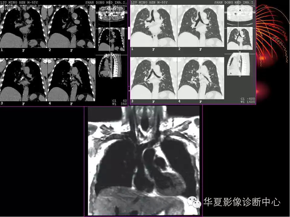 肺与纵隔的影像诊断