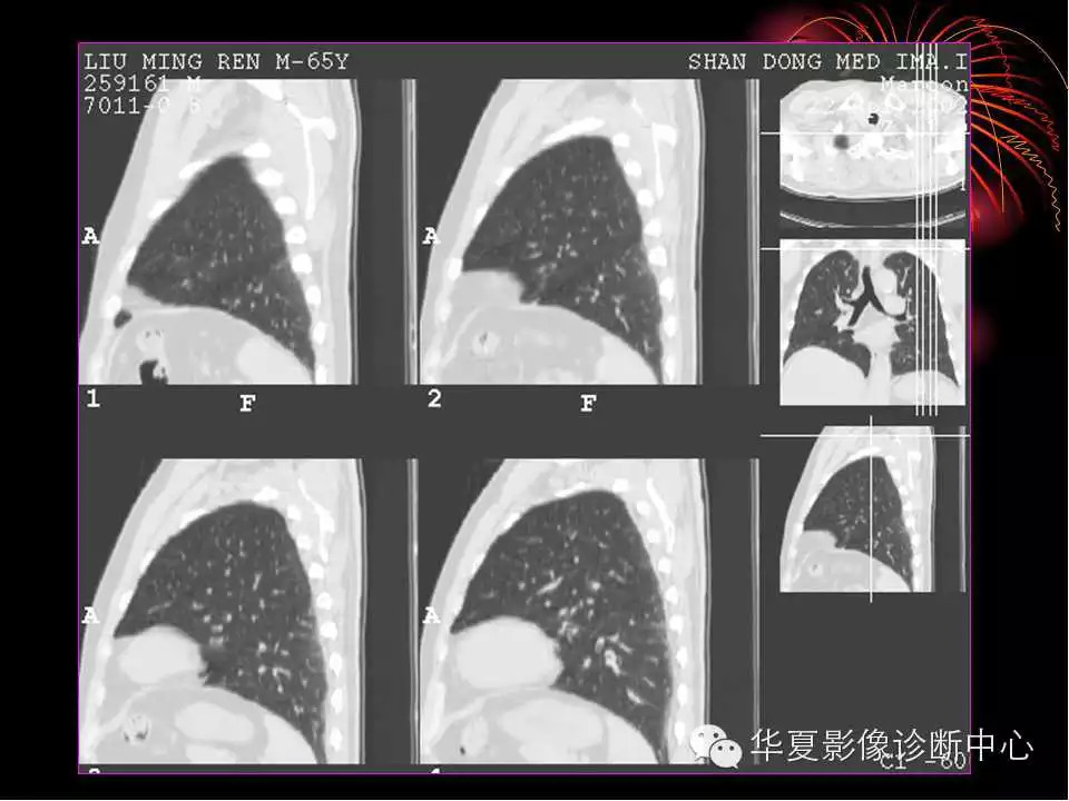 肺与纵隔的影像诊断