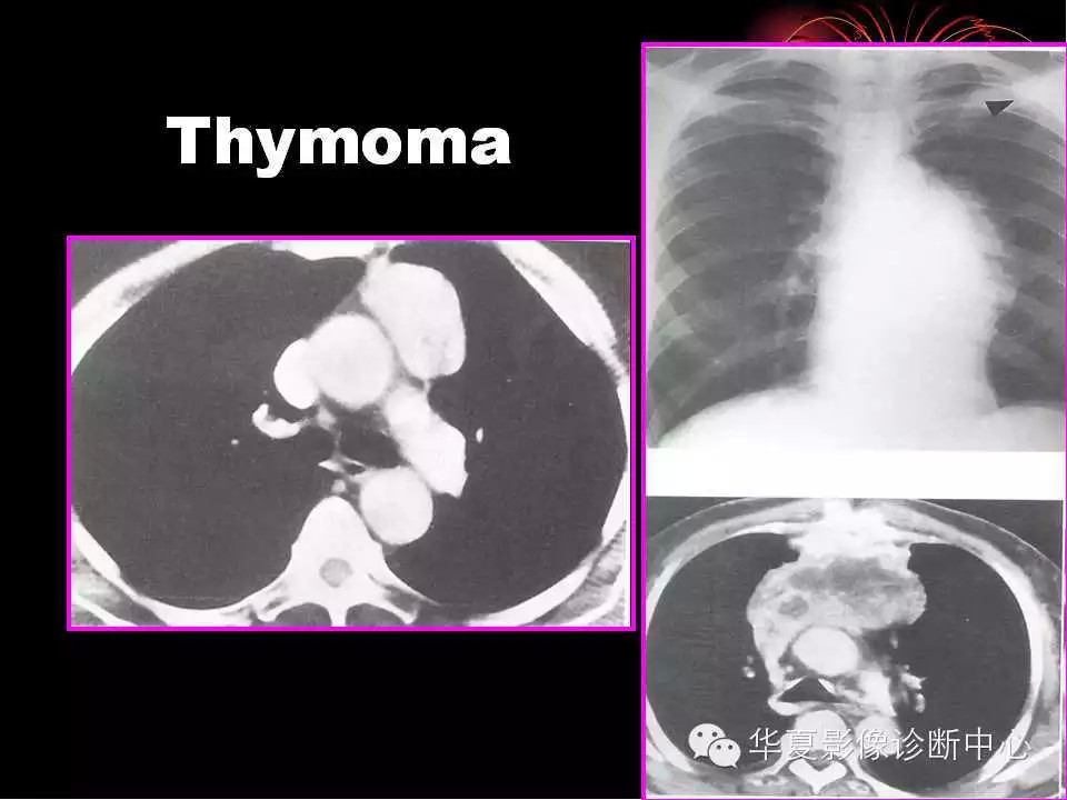 肺与纵隔的影像诊断
