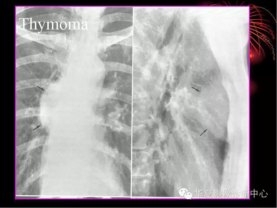 肺与纵隔的影像诊断